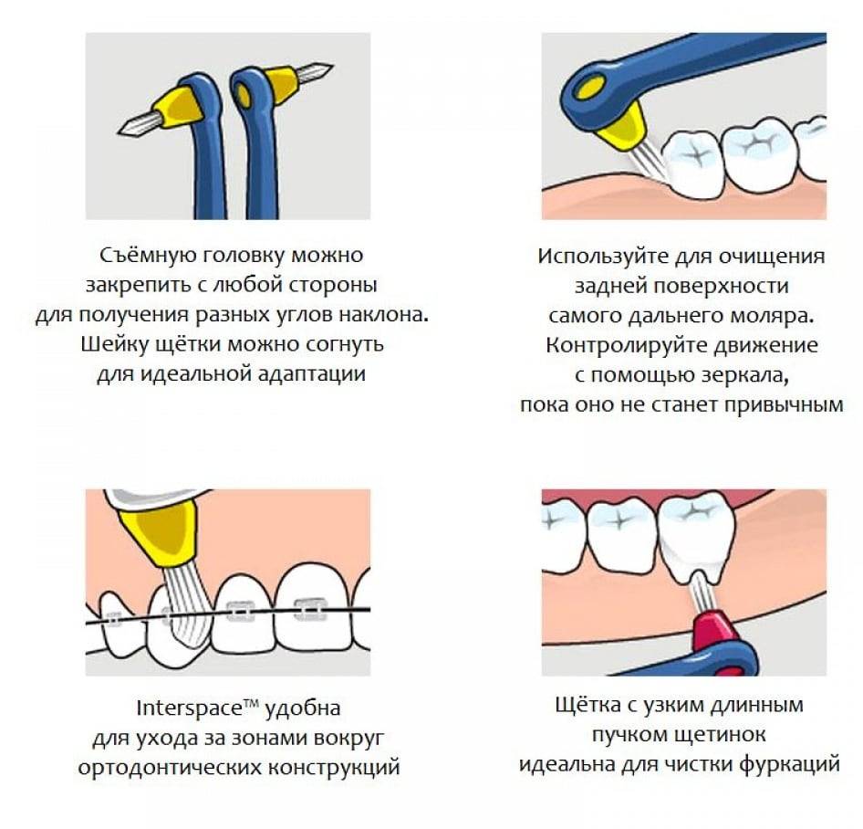 Гигиена во время ортодонтического лечения ⋆ orthogid.ru